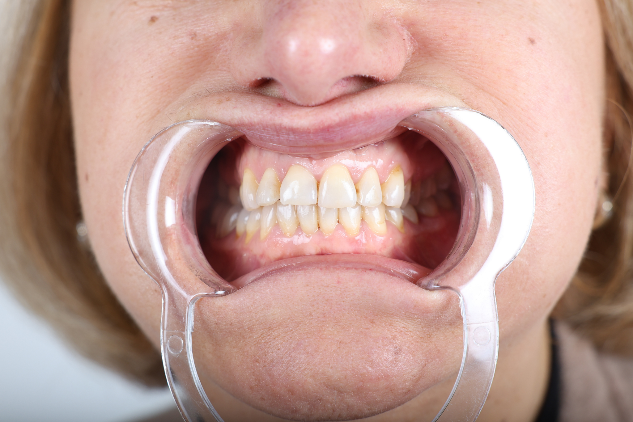 Before E-max Veneer Treatment